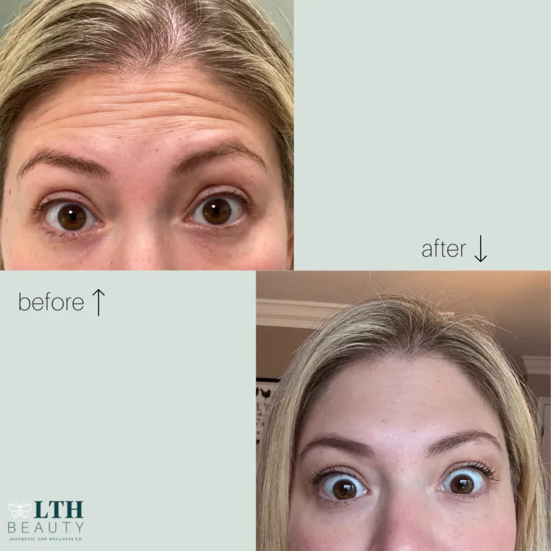 Before and after neurotoxin treatment — forehead wrinkles reduced
