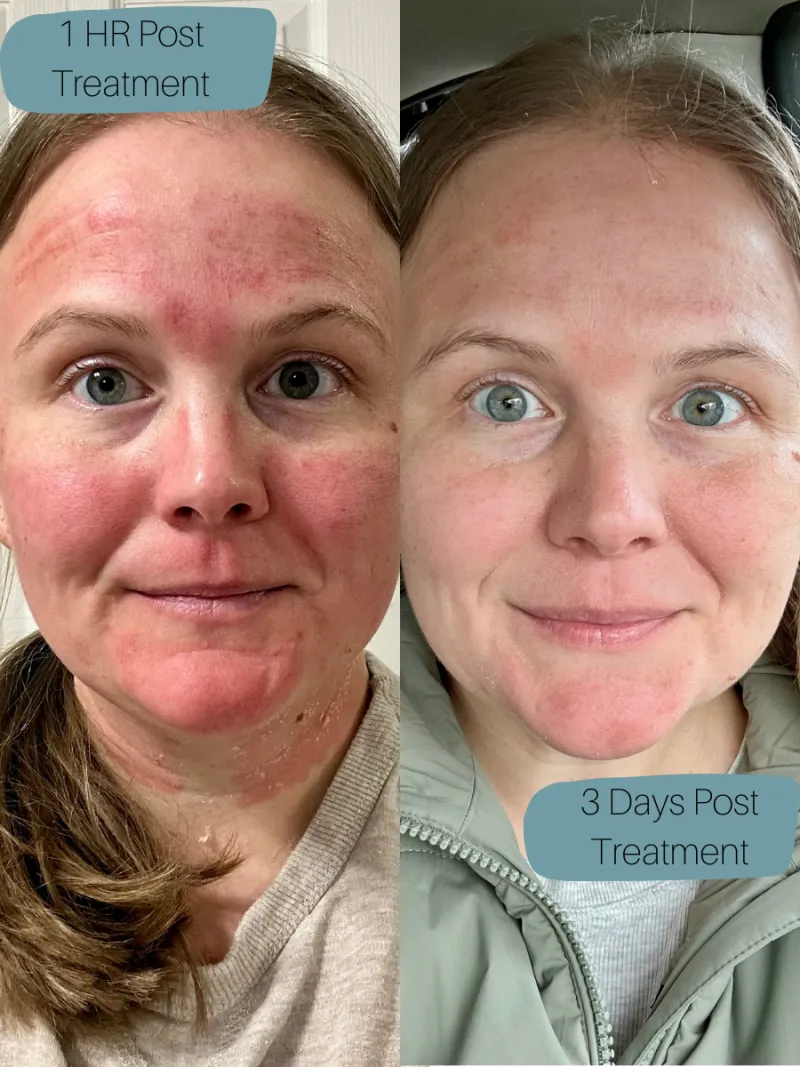 Microneedling recovery — 1 hour post treatment vs 3 days post treatment