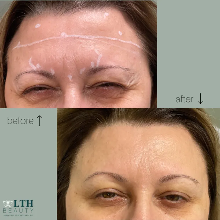 Before and after: frown lines