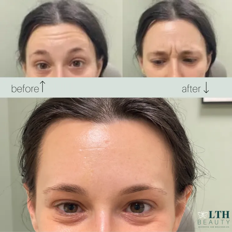 Before and after: forehead lines